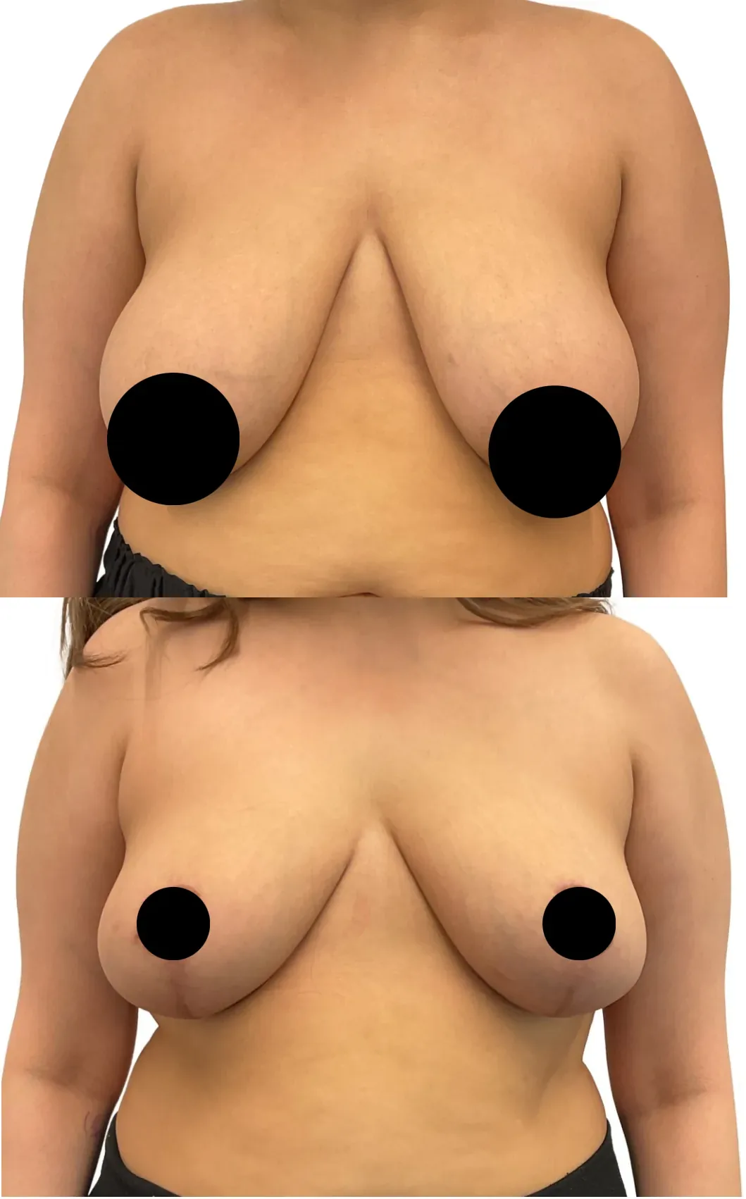 Breast lift with reduction, before, front view