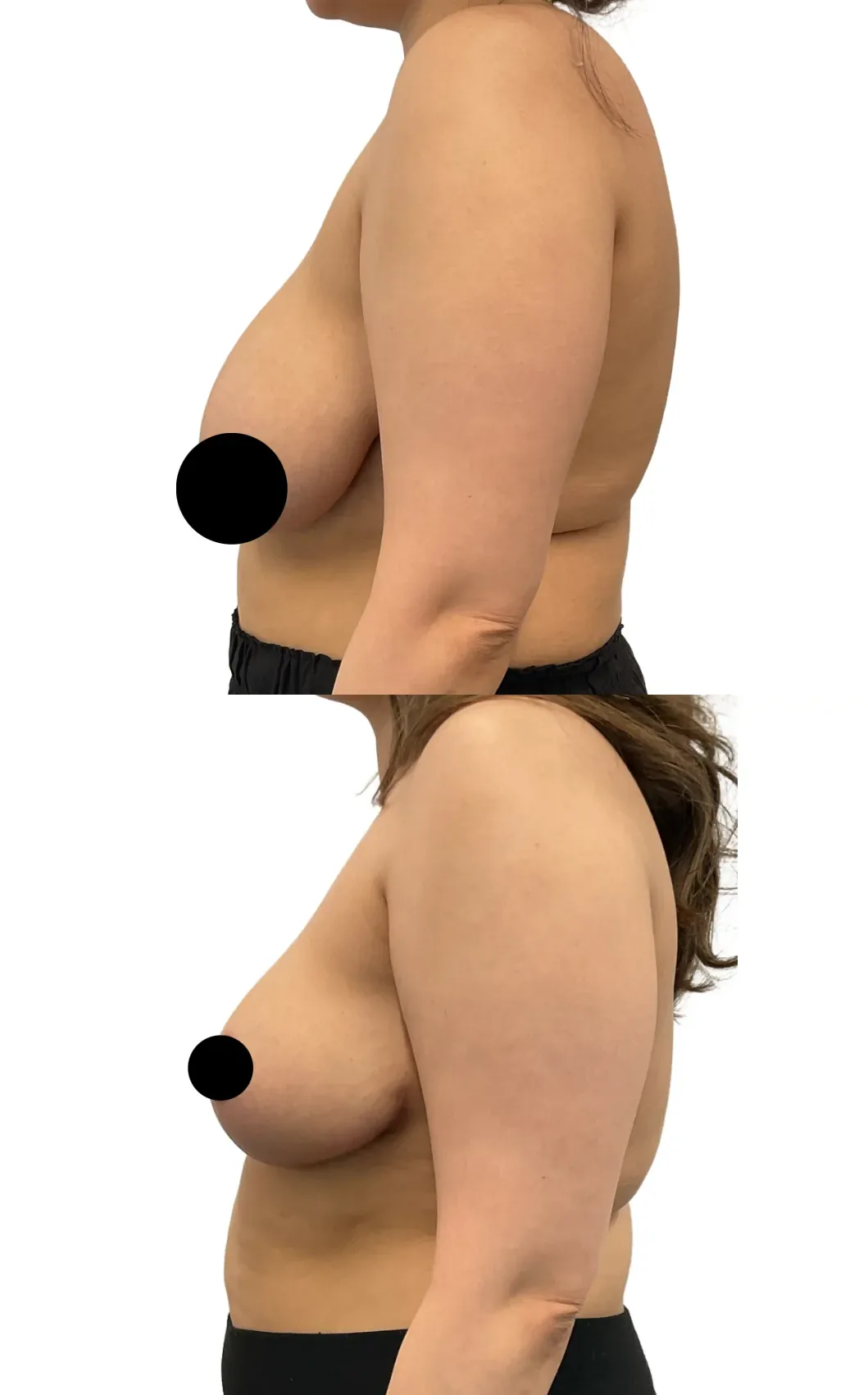 Breast lift with reduction, before, left side