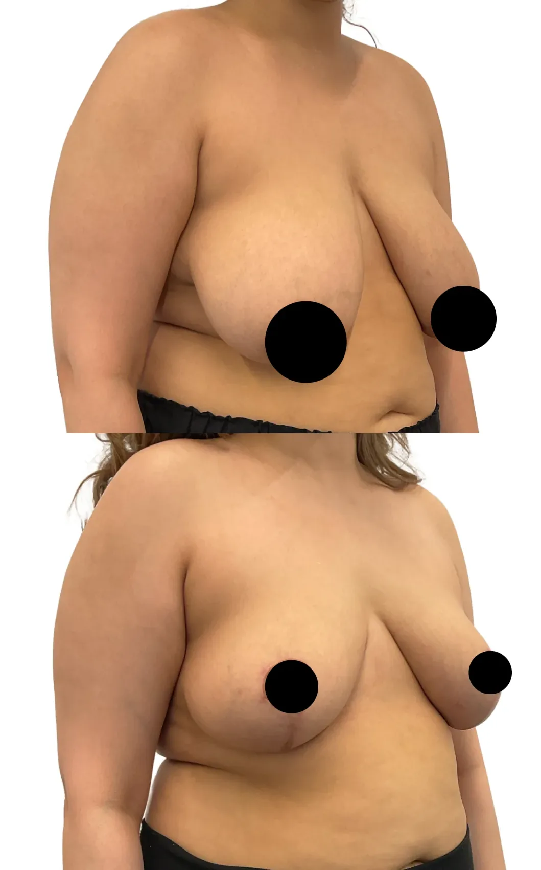 Breast lift with reduction, before, right oblique view