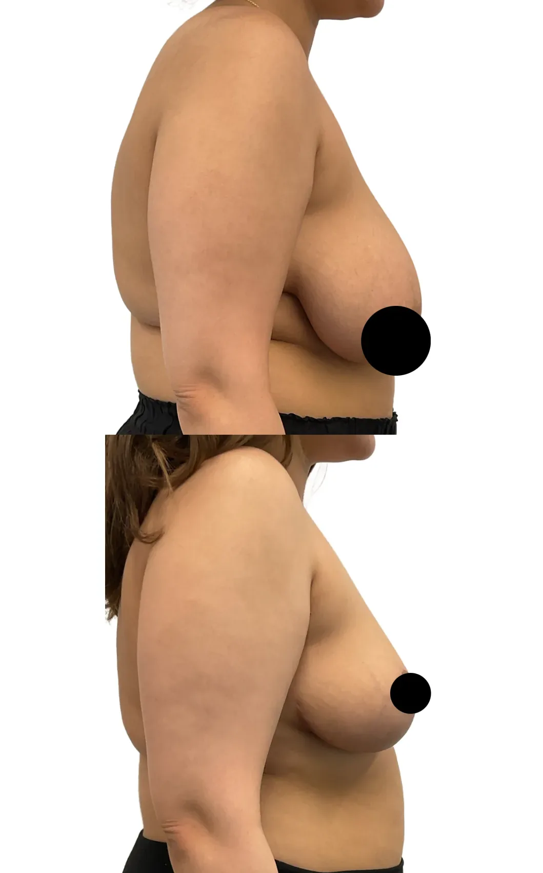 Breast lift with reduction, before, right side