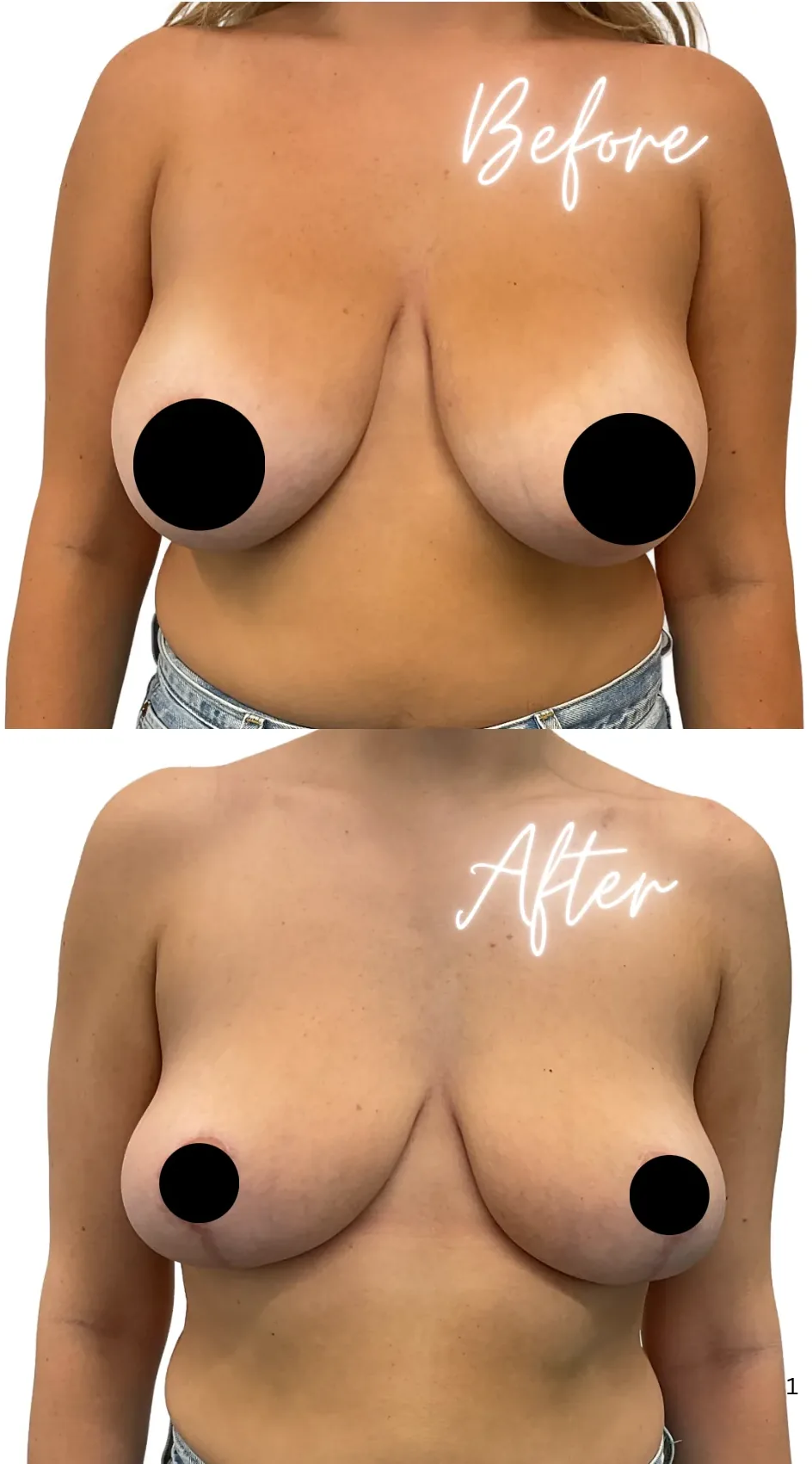 Breast lift with reduction, before, front view