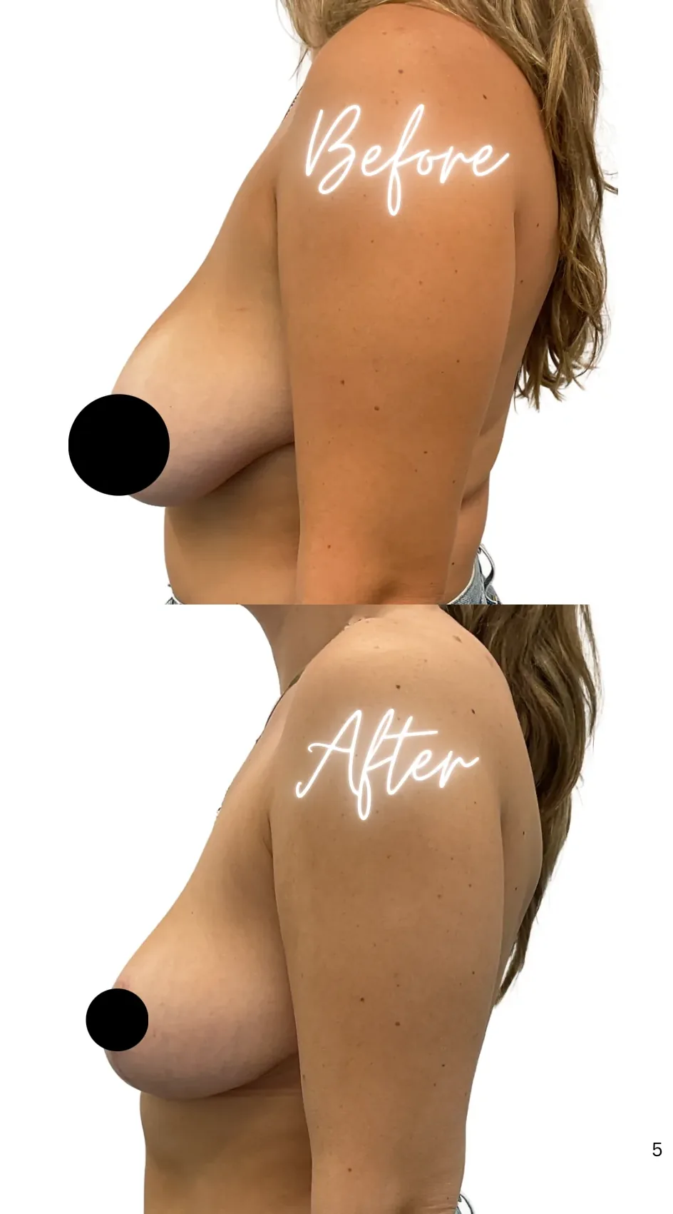 Breast lift with reduction, before, left side