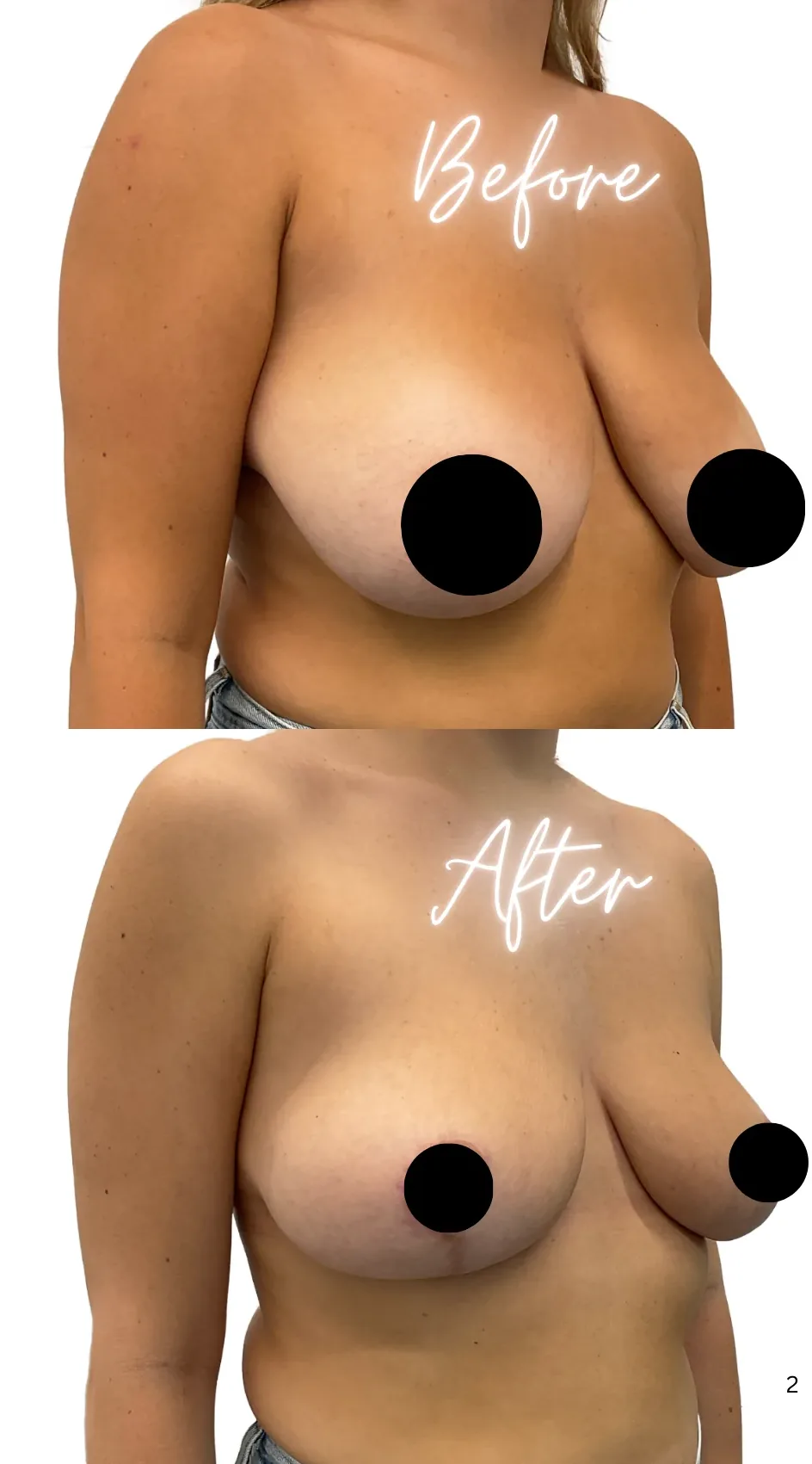 Breast lift with reduction, before, right oblique view