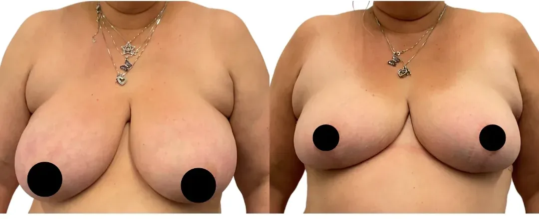Breast lift with reduction, before and after, front view