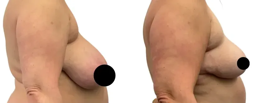 Breast lift with reduction, before and after, right profile