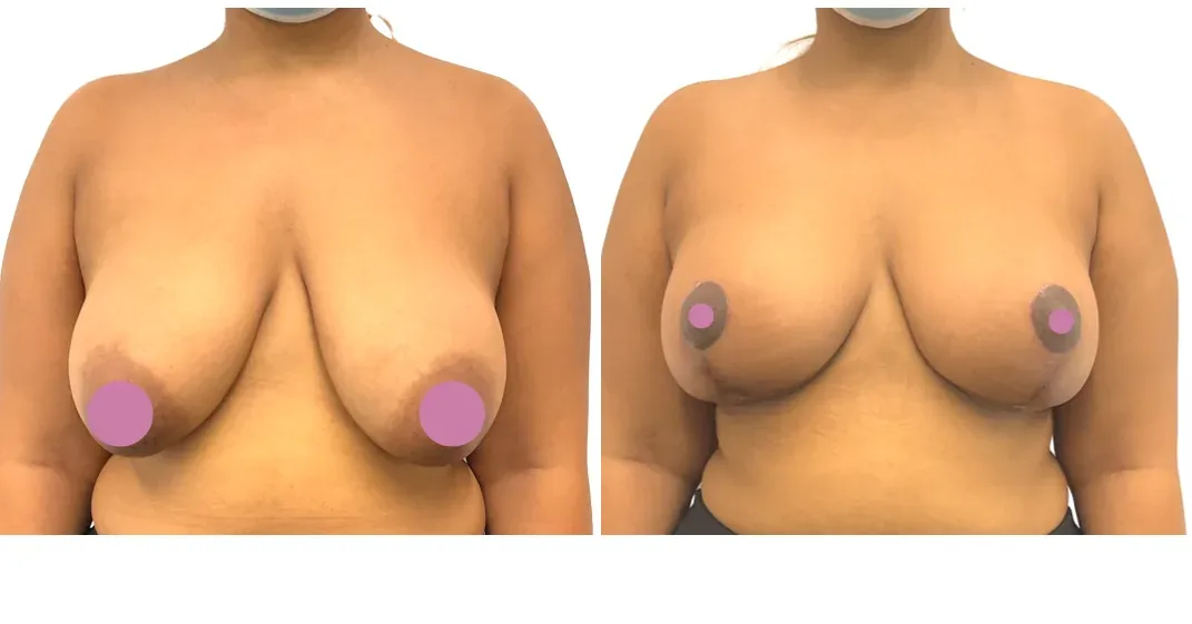 Breast lift with reduction, before and after, front view