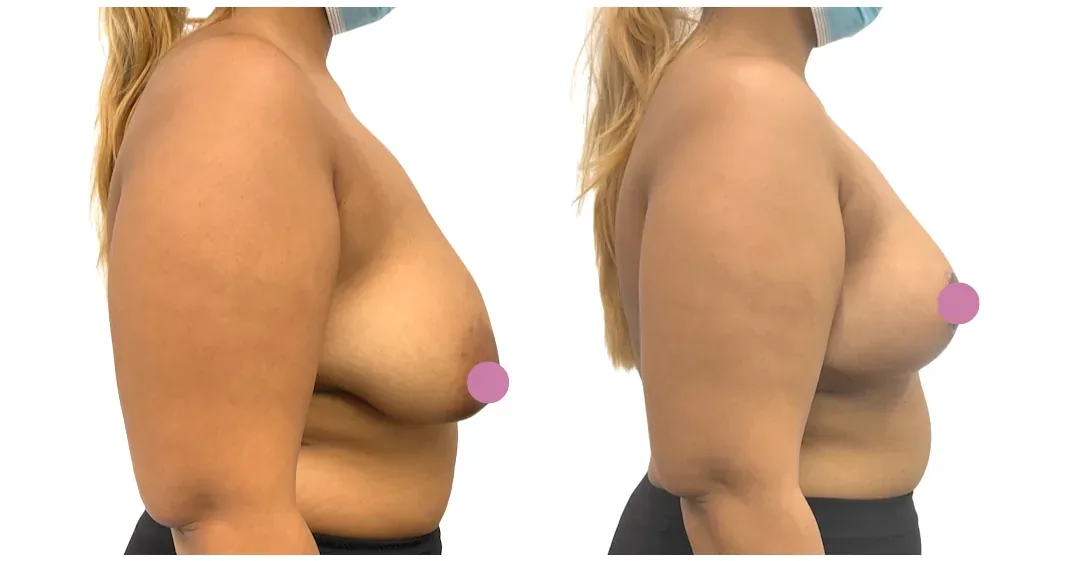 Breast lift with reduction, before and after, right profile