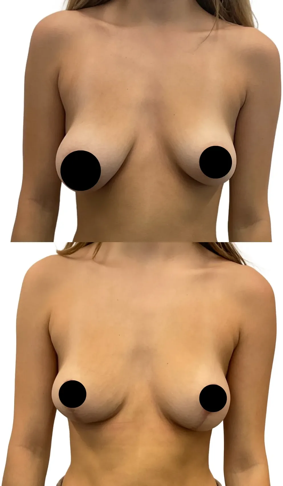 Breast Lift with Reduction on One Side, before, front view