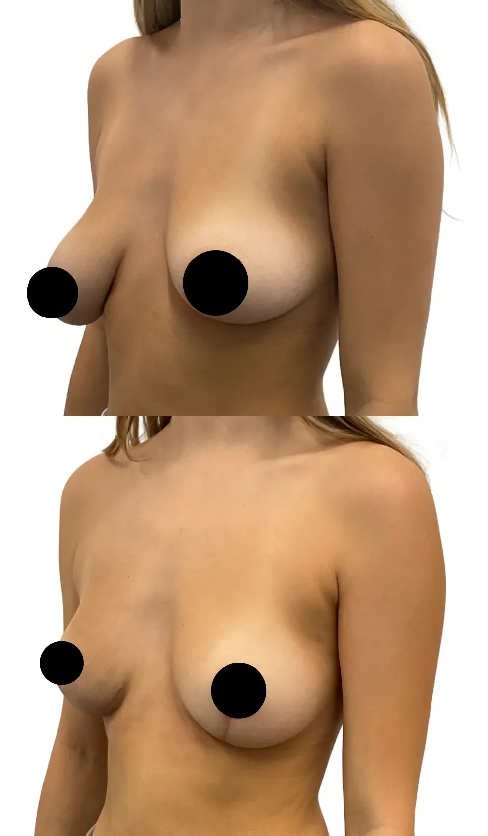 Breast Lift with Reduction on One Side, before, left oblique view