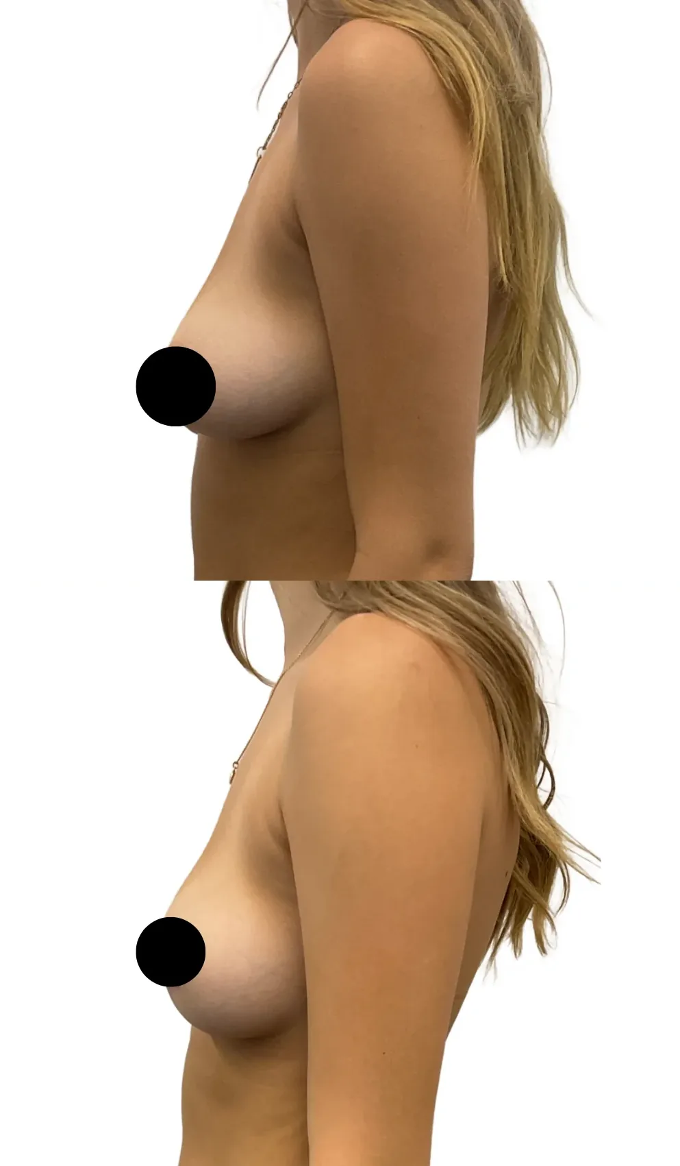 Breast Lift with Reduction on One Side, before, left profile