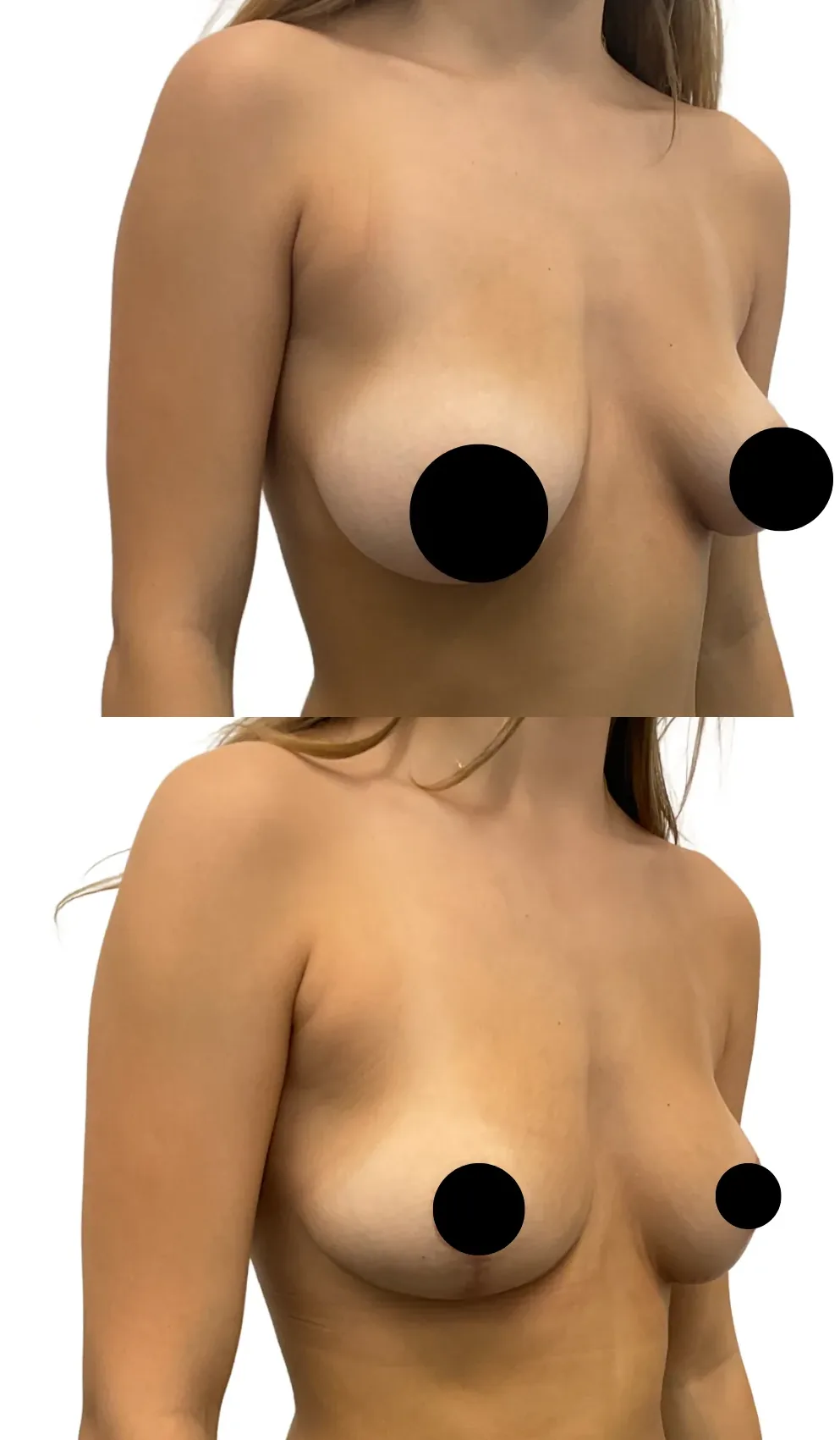 Breast Lift with Reduction on One Side, before, right oblique view