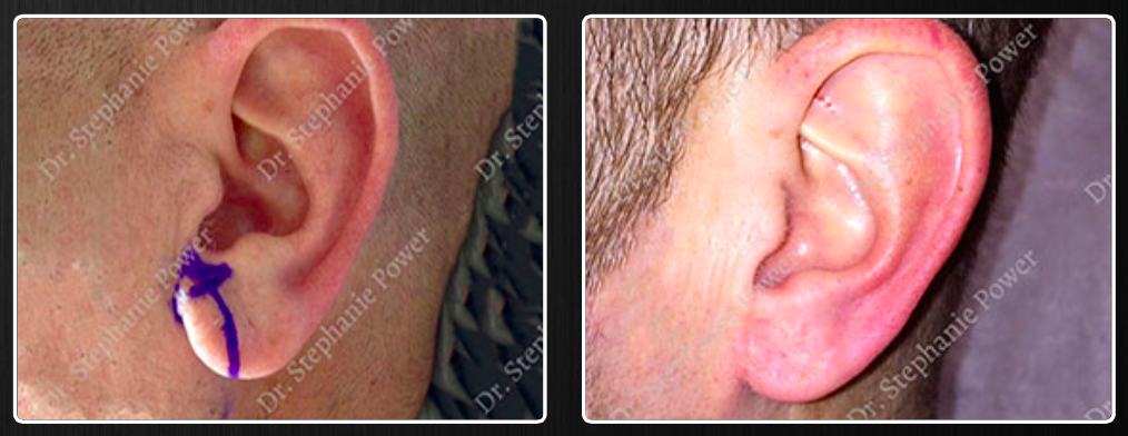 Earlobe Repair Surgery  Sound Plastic Surgery, Cosmetic Plastic