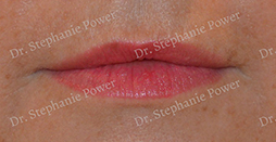 https://www.powerplasticsurgery.com/wp-content/uploads/2020/07/FatGraft_UpperLip_pre-cropped-Toronto-Ontario-Canada.jpg