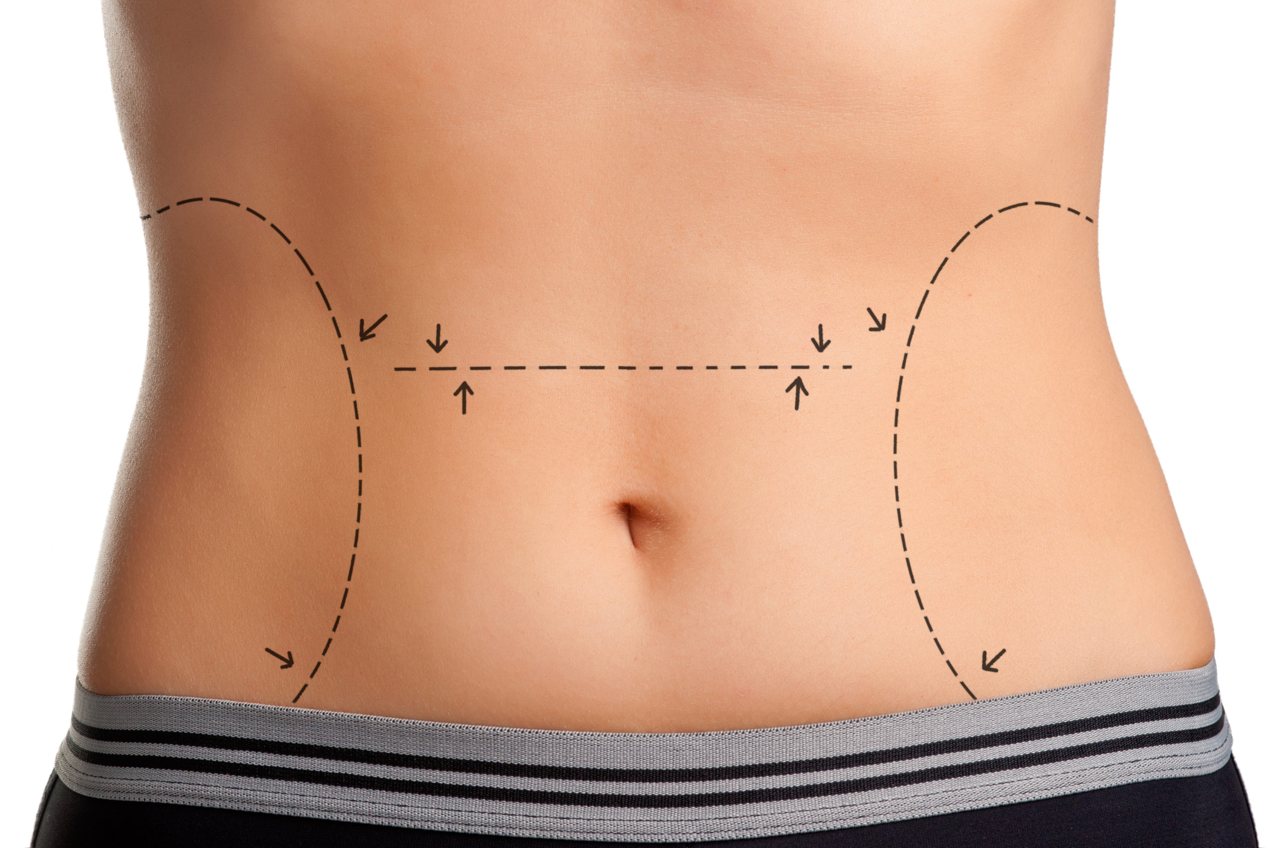 Does tummy tuck remove stretch marks