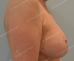 https://www.powerplasticsurgery.com/wp-content/uploads/2020/07/breast-lift-post-op-WM-side_cropped-Toronto-Ontario-Canada.jpg